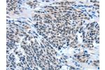 The image on the left is immunohistochemistry of paraffin-embedded Human esophagus cancer tissue using CSB-PA087889(EIF4EBP1 Antibody) at dilution 1/50, on the right is treated with fusion protein. (Original magnification: 