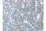 The image on the left is immunohistochemistry of paraffin-embedded Human thyroid cancer tissue using CSB-PA088258(CEACAM1 Antibody) at dilution 1/25, on the right is treated with fusion protein. (Original magnification: 