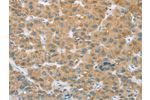 The image on the left is immunohistochemistry of paraffin-embedded Human liver cancer tissue using CSB-PA088788(CYP2C9 Antibody) at dilution 1/35, on the right is treated with fusion protein. (Original magnification: 