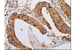 The image on the left is immunohistochemistry of paraffin-embedded Human colon cancer tissue using CSB-PA088834(ARF6 Antibody) at dilution 1/15, on the right is treated with synthetic peptide. (Original magnification: 