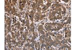 The image on the left is immunohistochemistry of paraffin-embedded Human liver cancer tissue using CSB-PA089265(FBP2 Antibody) at dilution 1/40, on the right is treated with fusion protein. (Original magnification: 
