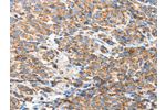 The image on the left is immunohistochemistry of paraffin-embedded Human esophagus cancer tissue using CSB-PA089402(BAK1 Antibody) at dilution 1/50, on the right is treated with fusion protein. (Original magnification: 