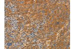 The image on the left is immunohistochemistry of paraffin-embedded Human liver cancer tissue using CSB-PA089809(APPL1 Antibody) at dilution 1/30, on the right is treated with fusion protein. (Original magnification: 