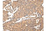 The image on the left is immunohistochemistry of paraffin-embedded Human prostate cancer tissue using CSB-PA090286(ALDH3A2 Antibody) at dilution 1/20, on the right is treated with fusion protein. (Original magnification: 