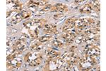 The image on the left is immunohistochemistry of paraffin-embedded Human thyroid cancer tissue using CSB-PA090482(ATRN Antibody) at dilution 1/30, on the right is treated with synthetic peptide. (Original magnification: 