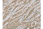 The image on the left is immunohistochemistry of paraffin-embedded Human gastic cancer tissue using CSB-PA090786(EEF2 Antibody) at dilution 1/20, on the right is treated with fusion protein. (Original magnification: 