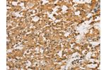 The image on the left is immunohistochemistry of paraffin-embedded Human thyroid cancer tissue using CSB-PA091163(ARHGEF5 Antibody) at dilution 1/50, on the right is treated with fusion protein. (Original magnification: 