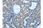 The image on the left is immunohistochemistry of paraffin-embedded Human thyroid cancer tissue using CSB-PA091269(ADCK4 Antibody) at dilution 1/30, on the right is treated with fusion protein. (Original magnification: 
