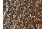 The image on the left is immunohistochemistry of paraffin-embedded Human liver cancer tissue using CSB-PA091770(CCR8 Antibody) at dilution 1/20, on the right is treated with synthetic peptide. (Original magnification: 