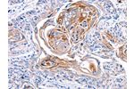 The image on the left is immunohistochemistry of paraffin-embedded Human esophagus cancer tissue using CSB-PA092112(CX3CL1 Antibody) at dilution 1/30, on the right is treated with synthetic peptide. (Original magnification: 