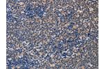 The image on the left is immunohistochemistry of paraffin-embedded Human lymphoma tissue using CSB-PA092883(ALG12 Antibody) at dilution 1/20, on the right is treated with fusion protein. (Original magnification: 