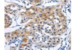 The image on the left is immunohistochemistry of paraffin-embedded Human lung cancer tissue using CSB-PA093051(GJB3 Antibody) at dilution 1/15, on the right is treated with synthetic peptide. (Original magnification: 
