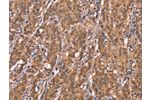 The image on the left is immunohistochemistry of paraffin-embedded Human gastic cancer tissue using CSB-PA093129(FBXO31 Antibody) at dilution 1/40, on the right is treated with synthetic peptide. (Original magnification: 