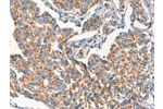 The image on the left is immunohistochemistry of paraffin-embedded Human breast cancer tissue using CSB-PA093388(DSP Antibody) at dilution 1/15, on the right is treated with synthetic peptide. (Original magnification: 