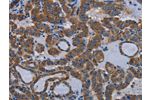 The image on the left is immunohistochemistry of paraffin-embedded Human thyroid cancer tissue using CSB-PA093669(EDNRB Antibody) at dilution 1/30, on the right is treated with synthetic peptide. (Original magnification: 