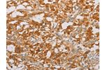 The image on the left is immunohistochemistry of paraffin-embedded Human thyroid cancer tissue using CSB-PA093779(BNIP3 Antibody) at dilution 1/20, on the right is treated with fusion protein. (Original magnification: 