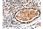 The image on the left is immunohistochemistry of paraffin-embedded Human stomach cancer tissue using CSB-PA094007(DNMT3A Antibody) at dilution 1/65, on the right is treated with fusion protein. (Original magnification: 