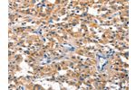 The image on the left is immunohistochemistry of paraffin-embedded Human thyroid cancer tissue using CSB-PA094054(DUSP2 Antibody) at dilution 1/30, on the right is treated with synthetic peptide. (Original magnification: 