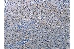 The image on the left is immunohistochemistry of paraffin-embedded Human liver cancer tissue using CSB-PA094273(DEFA1 Antibody) at dilution 1/10, on the right is treated with synthetic peptide. (Original magnification: 