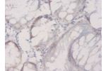 Immunohistochemistry of paraffin-embeded human colorectal carcinoma using CSB-PA09429A0Rb at dilution of 1:50