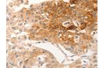 The image on the left is immunohistochemistry of paraffin-embedded Human lung cancer tissue using CSB-PA094529(CSF3R Antibody) at dilution 1/12, on the right is treated with synthetic peptide. (Original magnification: 