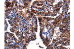 The image on the left is immunohistochemistry of paraffin-embedded Human thyroid cancer tissue using CSB-PA095417(GIP Antibody) at dilution 1/15, on the right is treated with fusion protein. (Original magnification: 