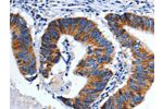 The image on the left is immunohistochemistry of paraffin-embedded Human colon cancer tissue using CSB-PA096500(CHRM2 Antibody) at dilution 1/3, on the right is treated with fusion protein. (Original magnification: 