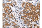 The image on the left is immunohistochemistry of paraffin-embedded Human gastic cancer tissue using CSB-PA096507(CTNNA1 Antibody) at dilution 1/35, on the right is treated with fusion protein. (Original magnification: 