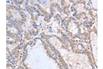 The image on the left is immunohistochemistry of paraffin-embedded Human thyroid cancer tissue using CSB-PA096831(ACVR1C Antibody) at dilution 1/15, on the right is treated with fusion protein. (Original magnification: 