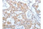 The image on the left is immunohistochemistry of paraffin-embedded Human lung cancer tissue using CSB-PA097333(CEACAM5 Antibody) at dilution 1/40, on the right is treated with synthetic peptide. (Original magnification: 