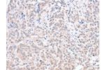 The image on the left is immunohistochemistry of paraffin-embedded Human esophagus cancer tissue using CSB-PA097487(ACOT1 Antibody) at dilution 1/30, on the right is treated with fusion protein. (Original magnification: 