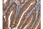 The image on the left is immunohistochemistry of paraffin-embedded Human colon cancer tissue using CSB-PA097491(EVC2 Antibody) at dilution 1/40, on the right is treated with synthetic peptide. (Original magnification: 