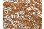 The image on the left is immunohistochemistry of paraffin-embedded Human gastic cancer tissue using CSB-PA097710(DEAF1 Antibody) at dilution 1/40, on the right is treated with synthetic peptide. (Original magnification: 