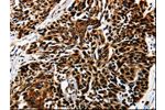 The image is immunohistochemistry of paraffin-embedded Human esophagus cancer tissue using CSB-PA098004(AKT1 Antibody) at dilution 1/25. (Original magnification: 