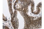 The image on the left is immunohistochemistry of paraffin-embedded Human colon cancer tissue using CSB-PA098010(CMTM2 Antibody) at dilution 1/60, on the right is treated with fusion protein. (Original magnification: 