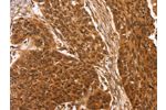 The image on the left is immunohistochemistry of paraffin-embedded Human esophagus cancer tissue using CSB-PA098232(CCND2 Antibody) at dilution 1/25, on the right is treated with synthetic peptide. (Original magnification: 