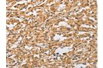 The image on the left is immunohistochemistry of paraffin-embedded Human thyroid cancer tissue using CSB-PA098497(ARMCX1 Antibody) at dilution 1/40, on the right is treated with fusion protein. (Original magnification: 
