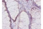 Immunohistochemistry of paraffin-embeded human colorectal carcinoma using CSB-PA09854A0Rb at dilution of 1:50
