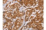 The image on the left is immunohistochemistry of paraffin-embedded Human esophagus cancer tissue using CSB-PA098689(CRYAB Antibody) at dilution 1/20, on the right is treated with fusion protein. (Original magnification: 