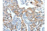 The image on the left is immunohistochemistry of paraffin-embedded Human lung cancer tissue using CSB-PA098902(AFAP1 Antibody) at dilution 1/20, on the right is treated with fusion protein. (Original magnification: 