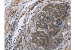 The image on the left is immunohistochemistry of paraffin-embedded Human cervical cancer tissue using CSB-PA098906(FANCG Antibody) at dilution 1/50, on the right is treated with fusion protein. (Original magnification: 