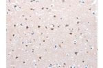 The image on the left is immunohistochemistry of paraffin-embedded Human brain cancer tissue using CSB-PA099030(FOXD2 Antibody) at dilution 1/25, on the right is treated with synthetic peptide. (Original magnification: 