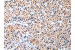 The image on the left is immunohistochemistry of paraffin-embedded Human liver cancer tissue using CSB-PA099227(CXCR4 Antibody) at dilution 1/20, on the right is treated with synthetic peptide. (Original magnification: 