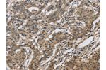 The image on the left is immunohistochemistry of paraffin-embedded Human gastic cancer tissue using CSB-PA099615(DHRS3 Antibody) at dilution 1/30, on the right is treated with fusion protein. (Original magnification: 