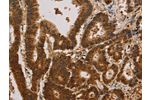 The image on the left is immunohistochemistry of paraffin-embedded Human colon cancer tissue using CSB-PA099774(CSNK2B Antibody) at dilution 1/30, on the right is treated with synthetic peptide. (Original magnification: 