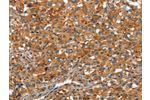 The image on the left is immunohistochemistry of paraffin-embedded Human thyroid cancer tissue using CSB-PA099883(ARPC2 Antibody) at dilution 1/30, on the right is treated with synthetic peptide. (Original magnification: 