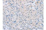 The image on the left is immunohistochemistry of paraffin-embedded Human liver cancer tissue using CSB-PA099944(EI24 Antibody) at dilution 1/25, on the right is treated with synthetic peptide. (Original magnification: 