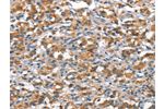 The image on the left is immunohistochemistry of paraffin-embedded Human thyroid cancer tissue using CSB-PA100422(ANP32C Antibody) at dilution 1/15, on the right is treated with synthetic peptide. (Original magnification: 