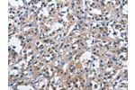 The image on the left is immunohistochemistry of paraffin-embedded Human thyroid cancer tissue using CSB-PA100599(CD244 Antibody) at dilution 1/40, on the right is treated with fusion protein. (Original magnification: 