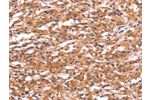 The image on the left is immunohistochemistry of paraffin-embedded Human thyroid cancer tissue using CSB-PA100614(GABRA1 Antibody) at dilution 1/30, on the right is treated with synthetic peptide. (Original magnification: 